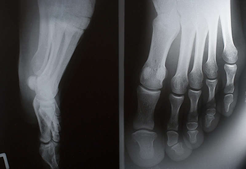 Xray feet